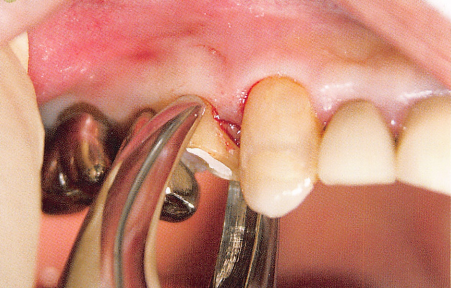 注意牙挺拔牙的技巧，千万别踩雷！