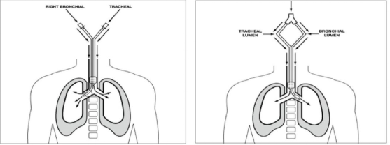 医用气管有哪些实用技术丨常规气管导管的7个结构细节&6种特殊类型的气管导管_https://www.jmylbn.com_新闻资讯_第20张