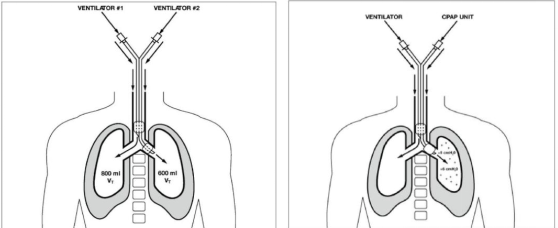 医用气管有哪些实用技术丨常规气管导管的7个结构细节&6种特殊类型的气管导管_https://www.jmylbn.com_新闻资讯_第21张