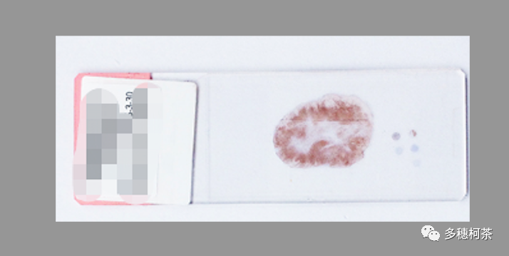 什么是病理蜡块癌症治疗中的白片、切片、染色片、蜡块是什么？看完这个，癌症治疗路上不折腾！_https://www.jmylbn.com_新闻资讯_第8张