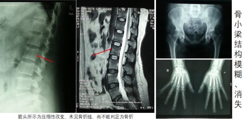 又雙叒叕1例骨痛來襲，這一次是咋回事？ 健康 第4張