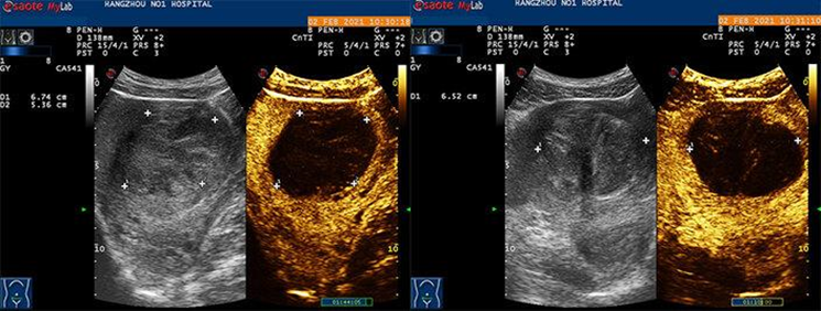 什么是超声容积探头超声造影，你了解吗？_https://www.jmylbn.com_新闻资讯_第1张