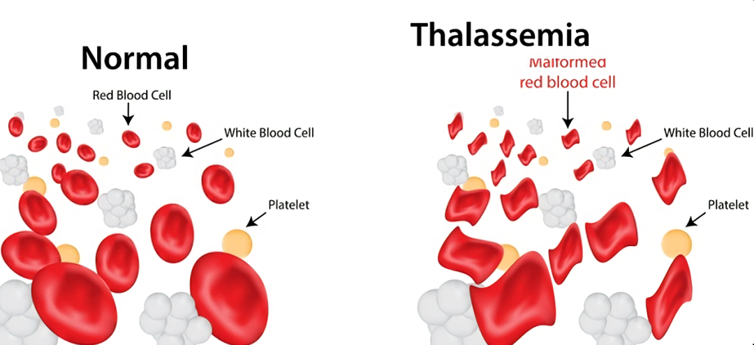 "地贫"患者孕育福音 三代试管省掉100万