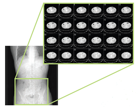设计仿真 | MSC Nastran助力Infosy公司精确评估骨折风险的图5