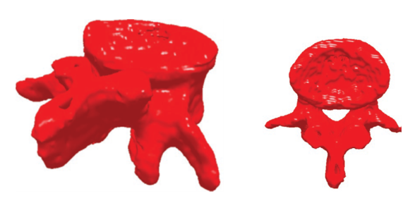 设计仿真 | MSC Nastran助力Infosy公司精确评估骨折风险的图2