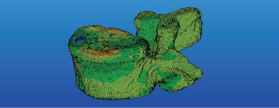 设计仿真 | MSC Nastran助力Infosy公司精确评估骨折风险的图1
