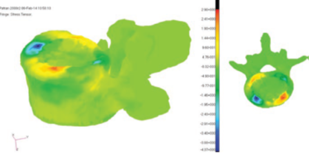 设计仿真 | MSC Nastran助力Infosy公司精确评估骨折风险的图4
