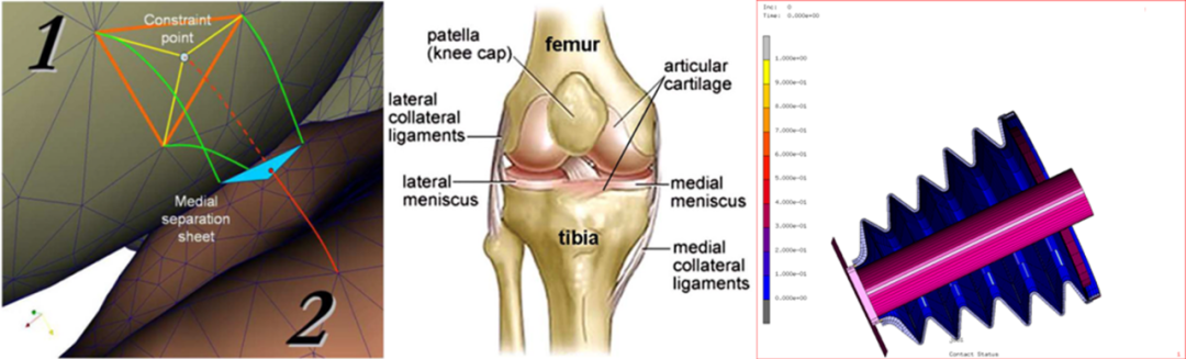 设计仿真 | 直播预告-Marc 仿真助力医学医疗研发创新的图5