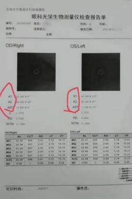 怎么测角膜直径【近视防控】一文读懂眼科光学生物测量之二——角膜曲率_https://www.jmylbn.com_新闻资讯_第12张