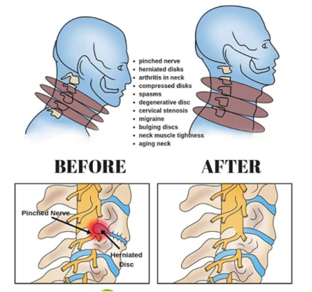 什么是费城颈托颈椎病患者看这里！你确定会选戴颈托吗？_https://www.jmylbn.com_新闻资讯_第8张