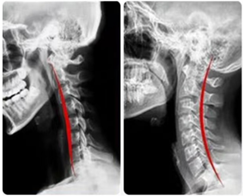什么是费城颈托颈椎病患者看这里！你确定会选戴颈托吗？_https://www.jmylbn.com_新闻资讯_第11张