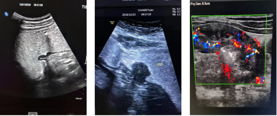 胃造影用的是什么机子【新技术 新项目】“超”能力 “胃”你解忧 ——胃肠不适怎么办，新医大二附院胃肠超声造影来帮你！_https://www.jmylbn.com_新闻资讯_第18张