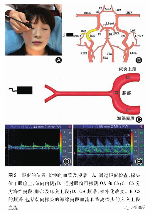 TCD怎么切换探头经颅多普勒超声的操作规范_https://www.jmylbn.com_新闻资讯_第9张