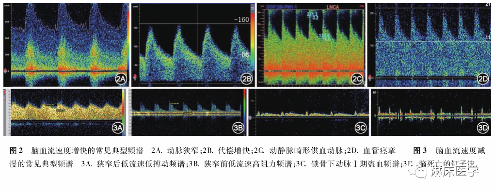 TCD怎么切换探头经颅多普勒超声的操作规范_https://www.jmylbn.com_新闻资讯_第7张