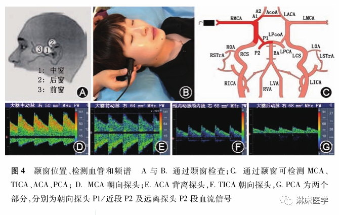 TCD怎么切换探头经颅多普勒超声的操作规范_https://www.jmylbn.com_新闻资讯_第8张