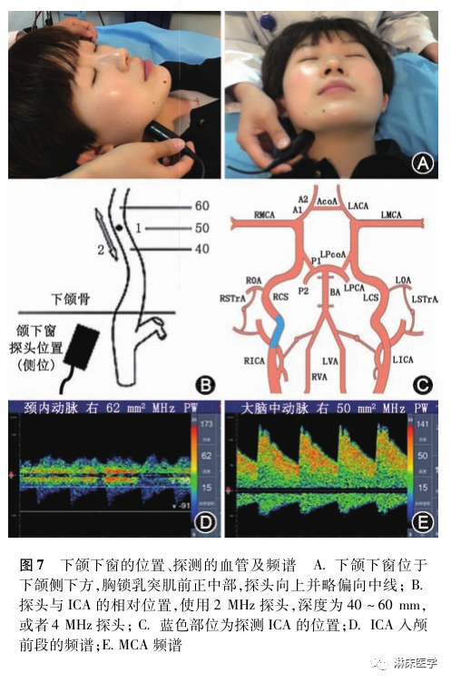 TCD怎么切换探头经颅多普勒超声的操作规范_https://www.jmylbn.com_新闻资讯_第11张