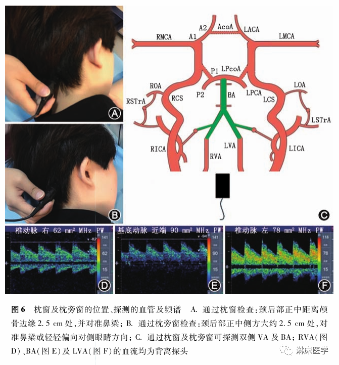 TCD怎么切换探头经颅多普勒超声的操作规范_https://www.jmylbn.com_新闻资讯_第10张