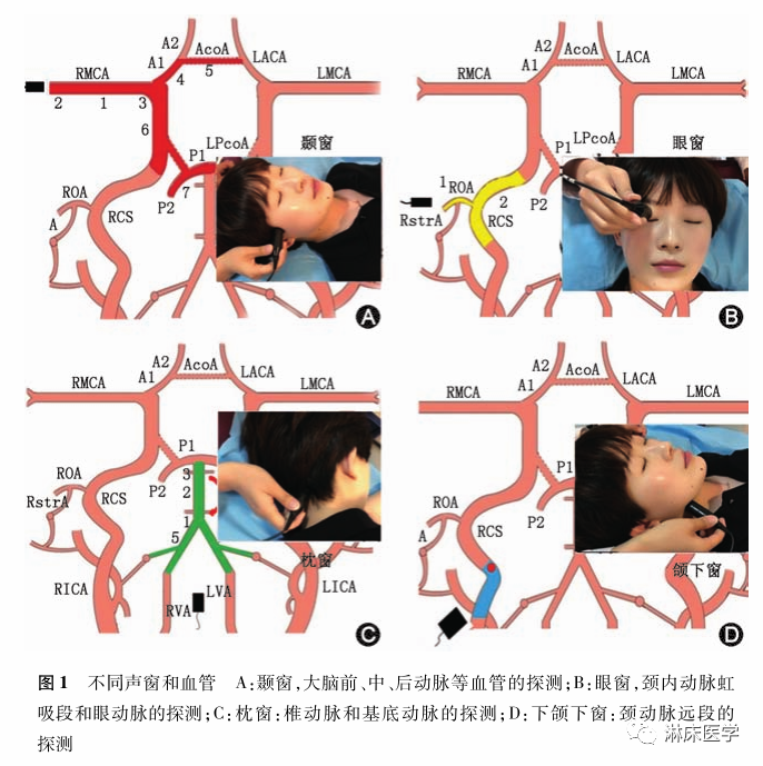 TCD怎么切换探头经颅多普勒超声的操作规范_https://www.jmylbn.com_新闻资讯_第6张