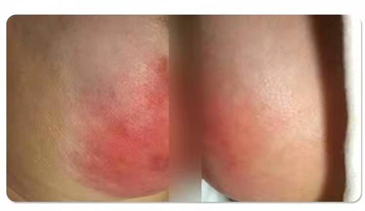 怎么撕敷料啊水胶体敷料的妙用，撕电极片时宝宝不再哭了！_https://www.jmylbn.com_新闻资讯_第2张