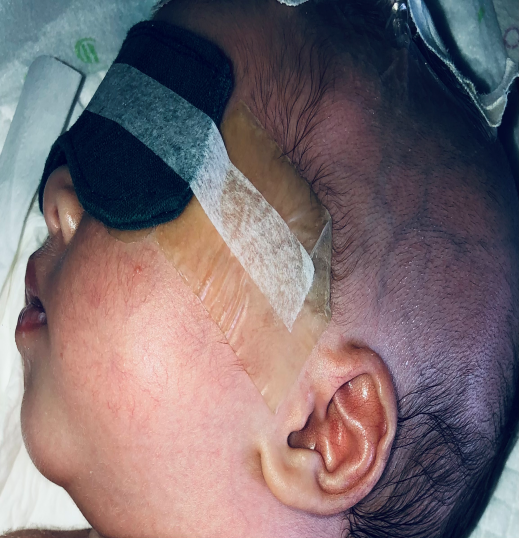 怎么撕敷料啊水胶体敷料的妙用，撕电极片时宝宝不再哭了！_https://www.jmylbn.com_新闻资讯_第9张