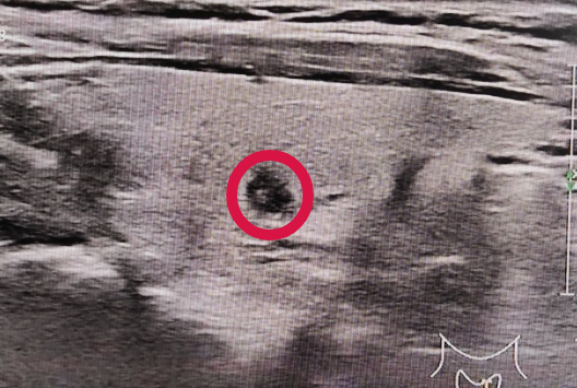 活检MM什么针功夫！_https://www.jmylbn.com_新闻资讯_第5张