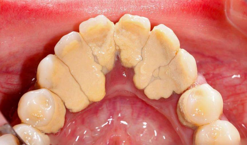 4大方法让你【永远】告别牙结石！