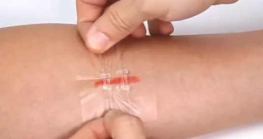 缝线器怎么用减张器有什么作用？_https://www.jmylbn.com_新闻资讯_第14张