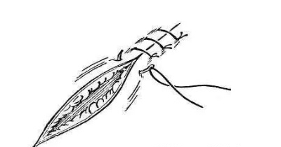 缝线器怎么用减张器有什么作用？_https://www.jmylbn.com_新闻资讯_第3张