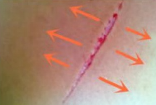 缝线器怎么用减张器有什么作用？_https://www.jmylbn.com_新闻资讯_第13张