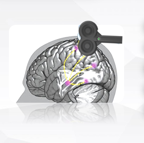 经颅磁治疗怎么样经颅磁刺激治疗脑卒中后遗症_https://www.jmylbn.com_新闻资讯_第10张