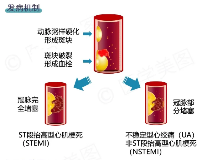 急性冠脉综合征的紧急救治