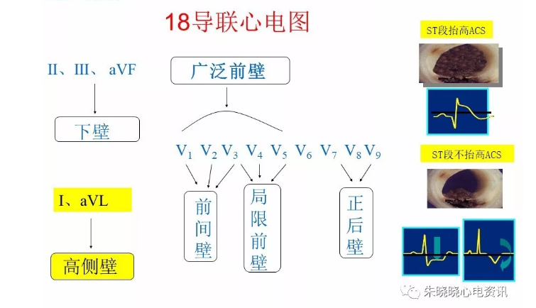 急性冠脉综合征的紧急救治