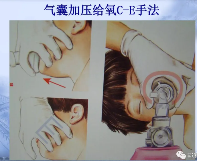 喉镜怎么选型号关于小儿气管插管术及并发症处理_https://www.jmylbn.com_新闻资讯_第11张