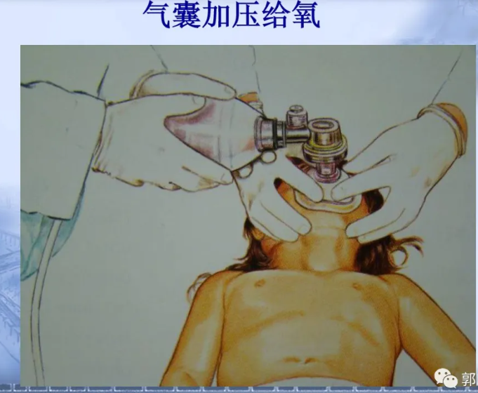 喉镜怎么选型号关于小儿气管插管术及并发症处理_https://www.jmylbn.com_新闻资讯_第12张