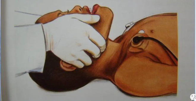 喉镜怎么选型号关于小儿气管插管术及并发症处理_https://www.jmylbn.com_新闻资讯_第23张