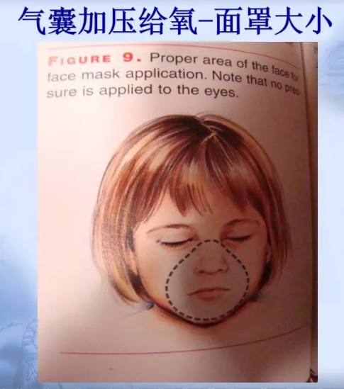 喉镜怎么选型号关于小儿气管插管术及并发症处理_https://www.jmylbn.com_新闻资讯_第9张