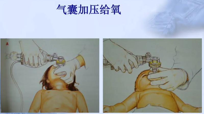 喉镜怎么选型号关于小儿气管插管术及并发症处理_https://www.jmylbn.com_新闻资讯_第10张