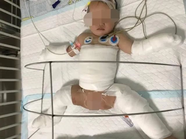 抗菌清创敷料怎么使用烧伤创面如何进行有效清创_https://www.jmylbn.com_新闻资讯_第9张