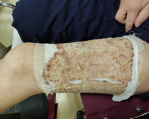 抗菌清创敷料怎么使用烧伤创面如何进行有效清创_https://www.jmylbn.com_新闻资讯_第10张