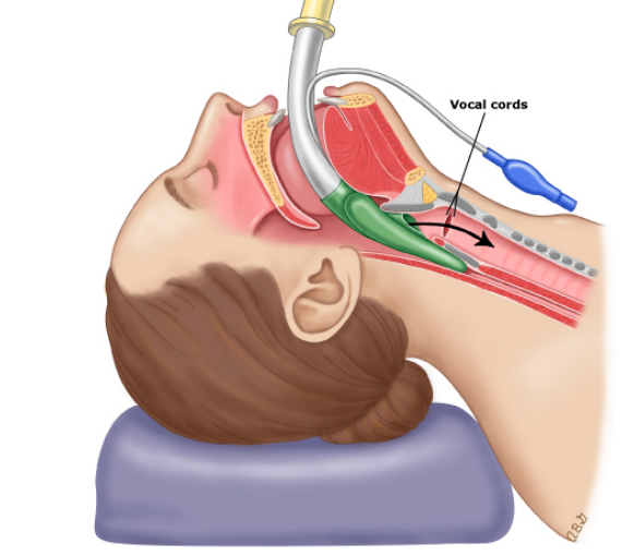 为什么要用喉罩急危重症必备：如何正确使用喉罩？_https://www.jmylbn.com_新闻资讯_第4张