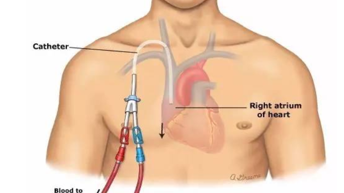 picc导管是什么材质【技术】picc置管技术及管路维护_https://www.jmylbn.com_新闻资讯_第2张