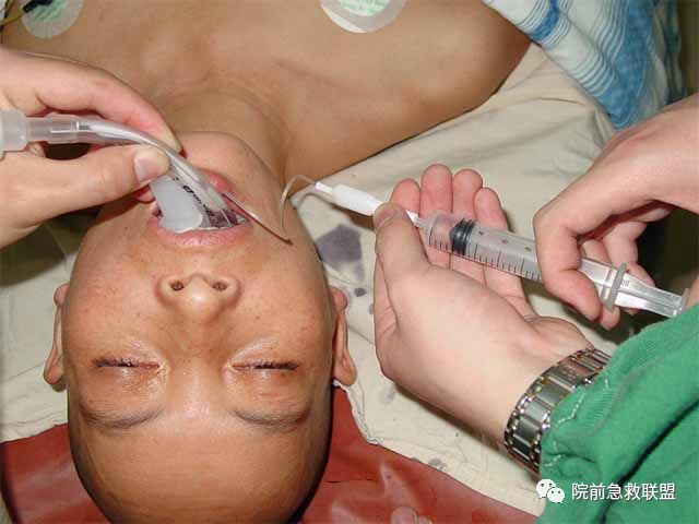 插管固定怎么安装气管插管操作流程及护理要点（附操作录相）_https://www.jmylbn.com_新闻资讯_第5张