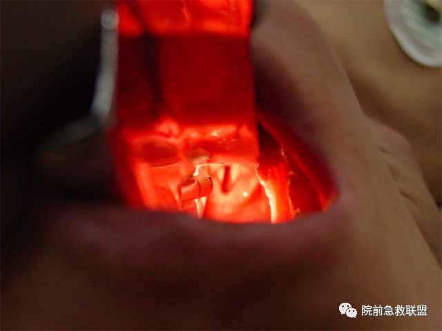 插管固定怎么安装气管插管操作流程及护理要点（附操作录相）_https://www.jmylbn.com_新闻资讯_第4张