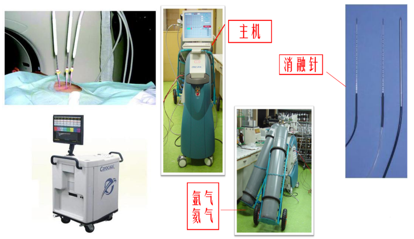 什么是氩气刀医加百科｜氩气刀是一种什么刀？_https://www.jmylbn.com_新闻资讯_第1张