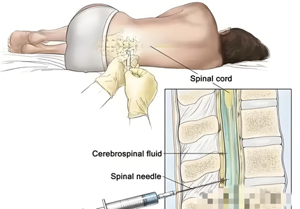 怎么上穿刺鞘【“绿色”抗癌视频】脑膜转移不再是“绝境”？腰穿鞘注化疗带来新转机！_https://www.jmylbn.com_新闻资讯_第8张