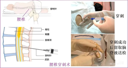 怎么上穿刺鞘【“绿色”抗癌视频】脑膜转移不再是“绝境”？腰穿鞘注化疗带来新转机！_https://www.jmylbn.com_新闻资讯_第6张