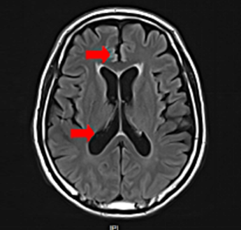怎么上穿刺鞘【“绿色”抗癌视频】脑膜转移不再是“绝境”？腰穿鞘注化疗带来新转机！_https://www.jmylbn.com_新闻资讯_第4张