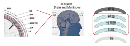 怎么上穿刺鞘【“绿色”抗癌视频】脑膜转移不再是“绝境”？腰穿鞘注化疗带来新转机！_https://www.jmylbn.com_新闻资讯_第5张
