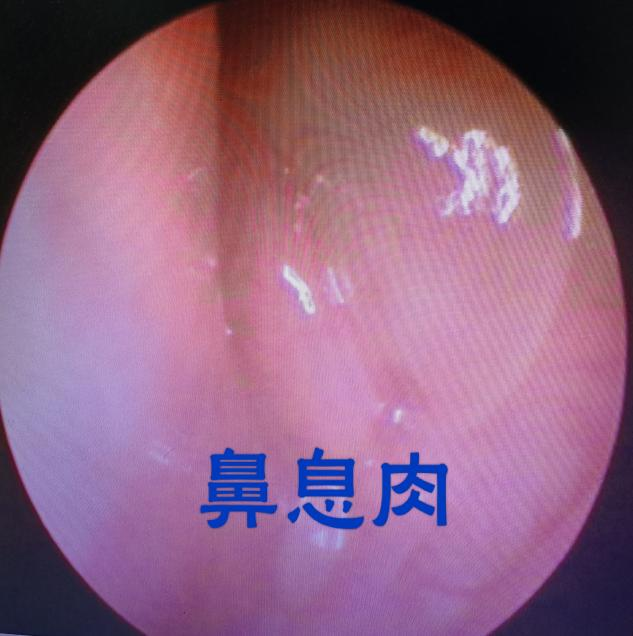 耳鼻喉内窥镜检查是检查什么耳鼻喉内窥镜可以检查哪些疾病？_https://www.jmylbn.com_新闻资讯_第11张