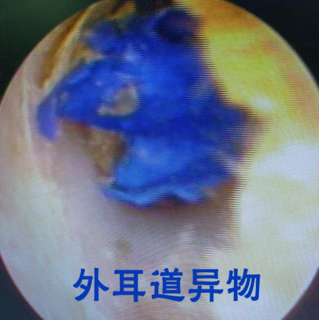 耳鼻喉内窥镜检查是检查什么耳鼻喉内窥镜可以检查哪些疾病？_https://www.jmylbn.com_新闻资讯_第10张